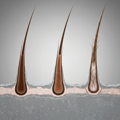 Microscopic view of hair follicles affected by DHT, with healthy and miniaturized follicles side-by-side on a scientific background, no text, no words, no typography, 8K