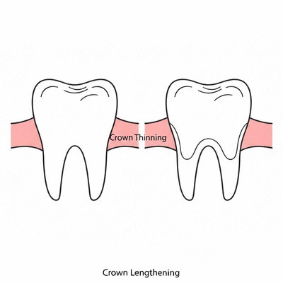 Stylized diagram comparing crown thinning and crown lengthening, clear visual representation of differences, no text, no words, no typography, clean image