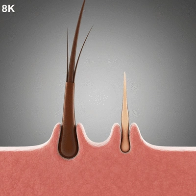Microscopic view of hair follicle miniaturization process caused by DHT